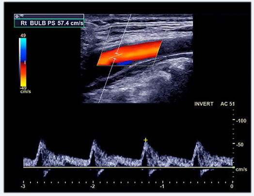 image description doppler arteriel
