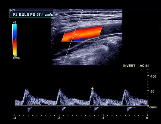image doppler arteriel