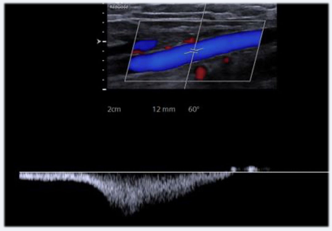 image description doppler veineux