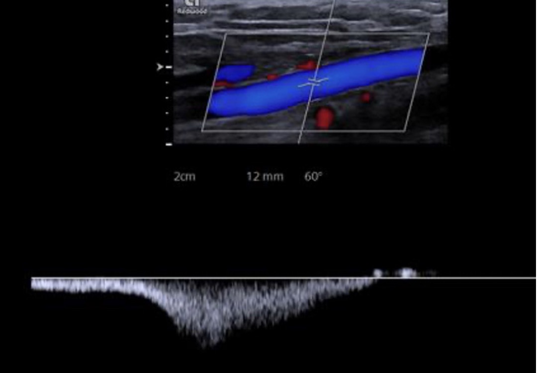 image doppler veineux
