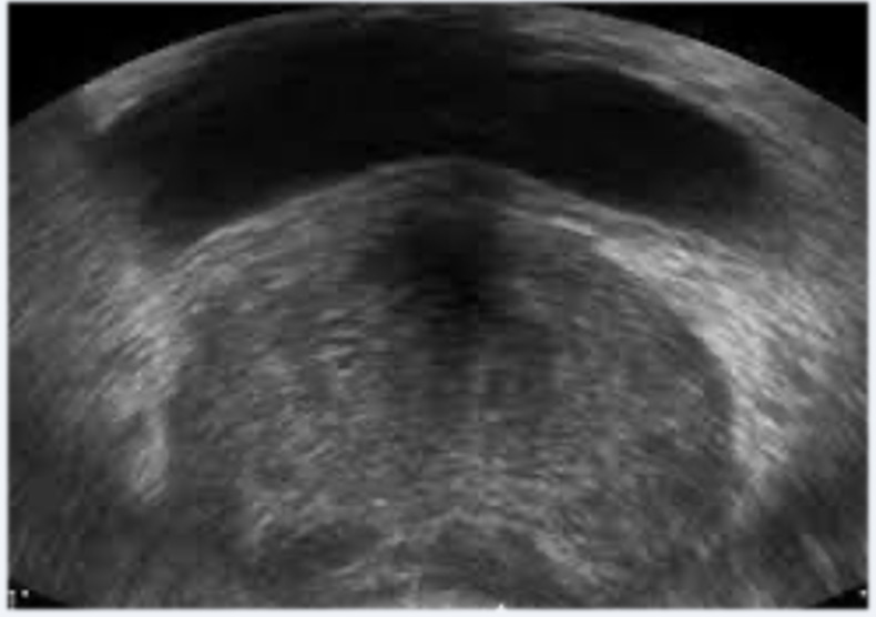 image description echographie prostatique