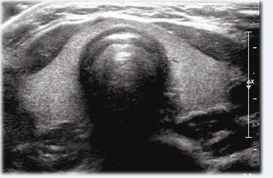 image description echographie de la thyroide