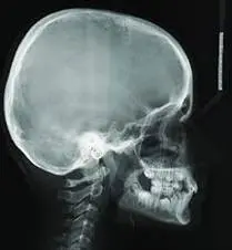 image description telecrane